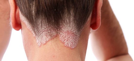 tinea-capitis